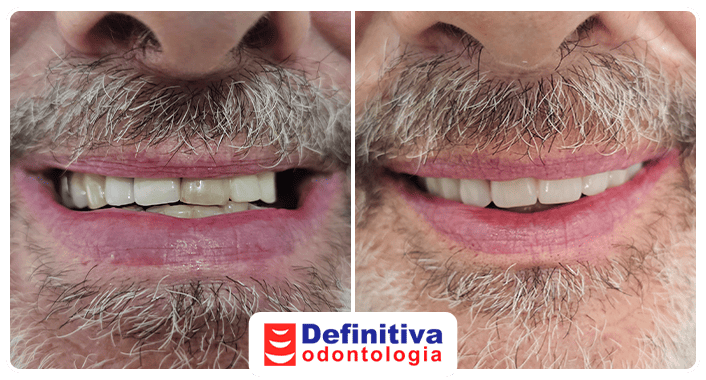 Antes e Depois
