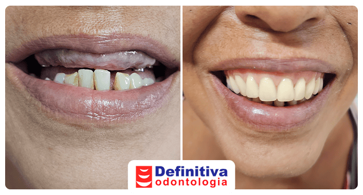 Antes e Depois